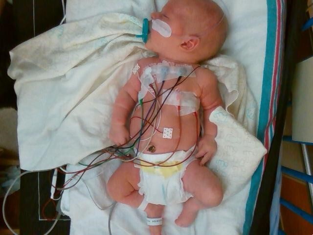 A NICU patient is continuously monitored using effective, yet cumbersome, wired sensors