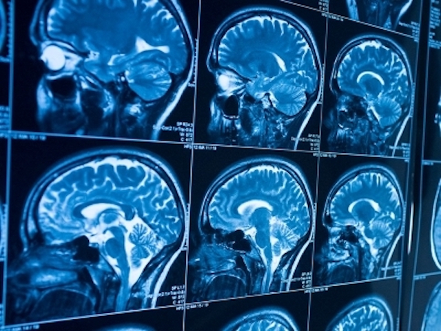 photo of blue brain scans